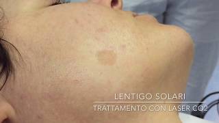 Lentigo solari  Trattamento con Laser CO2 [upl. by Anicart]