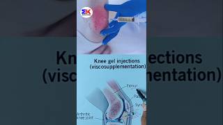 Knee Gel Injections Viscosupplementation shorts medicineknowledgehindi [upl. by Sidonie87]