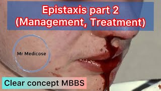 Epistaxis part 2 Management Treatment [upl. by Haddad]