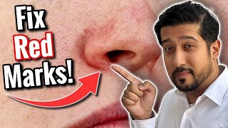 Redness Around Nose  Get Rid of Perioral Dermatitis FAST [upl. by Nolrac]