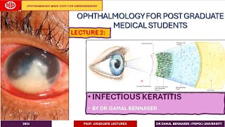 Infectious Keratitis STATE OF THE ART DIAGNOSIS AND MANAGMENT LECTURE 2 Bacterial KERATITIS [upl. by Loredo]