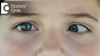 Can Exotropia be cured with eye drops or medicines  Dr Sirish Nelivigi [upl. by Ashlan547]