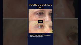 Comment traiter les poches sous les yeux à Paris en chirurgie esthétique [upl. by Hares]