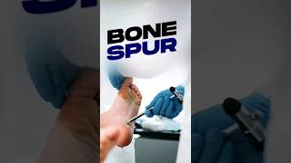 How Arthritis Leads to Cartilage Wear Bone Spurs and Joint Calcification [upl. by Llenyaj188]