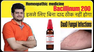 Best Homeopathic Medicine for Fungal Infection Ringworm or tinea corporis  Bacillinum 200 [upl. by Pacificia]