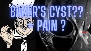 Bakers cyst Behind the knee pain Why you need to learn about it [upl. by Birdie]