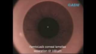 Bladeless Lasik Surgery – Femto Lasik Surgery performed by Dr Vandana Jain at AEHI Mumbai India [upl. by Everett]