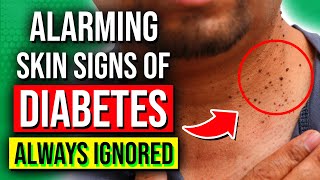 8 ALARMING Skin Signs Of Diabetes You Should NOT Ignore [upl. by Cardew513]