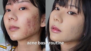 acne skin ʚɞ ༘⋆ acne coverage base routine  cover acne easily with makeup [upl. by Sagerman]