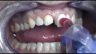 Prepless Veneers Procedure at Cosmetic Dental Associates San Antonio TX Dental Practice [upl. by Ecadnac]