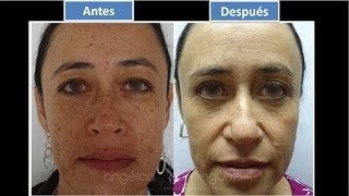 Tratamientos especializados para Manchas en la Cara Axilas Cuello Manos y cuerpo  Quitar Manchas [upl. by Ardnoyek]