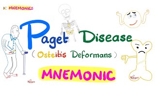 Paget Disease of Bone Osteitis Deformans  with a Mnemonic [upl. by Rekrap]