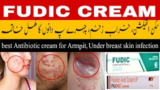 fudic cream uses  fusidic acid cream  antibacterial cream  best cream for acne  infected wound [upl. by Verlie]