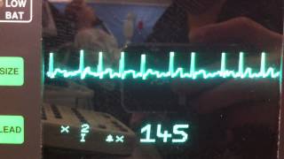 Atrial fibrillation ECG [upl. by Nereids]