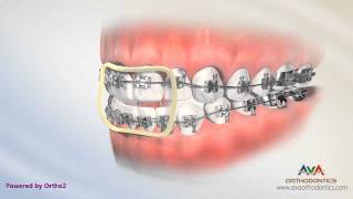 Orthodontic Treatment for Openbite  Rubber Bands [upl. by Terbecki]