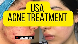 Top Acne Treatment Tips for Clear SkinUnited States Acne Treatment [upl. by Meekah131]