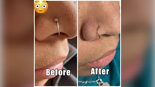 Get rid of that nose piercing bump FOR GOOD Find out what really works Easiest method [upl. by Ellimac238]