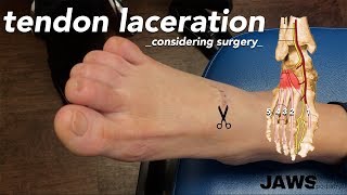 TENDON LACERATION ✂️✂️ [upl. by Keraj139]