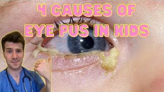 Doctor explains 4 causes of eye pus discharge or sticky eyes in kids  Doctor ODonovan [upl. by Harutek]