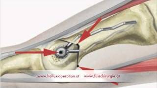 Hallux Operation nach Stoffella Teil 23 Osteotomie [upl. by Asina]