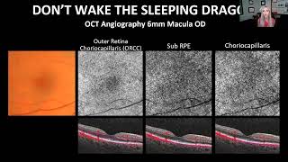 Mastering OCT Interpretation Through Case Analysis [upl. by Jeremias]