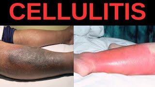 What is Cellulitis Symptoms Causes Treatment [upl. by Aivon]