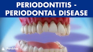 Gum disease  Periodontitis  Periodontal Disease © [upl. by Luar]