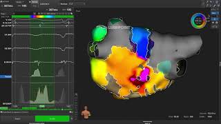 Left Atrial Flutter Case [upl. by Charlotta]