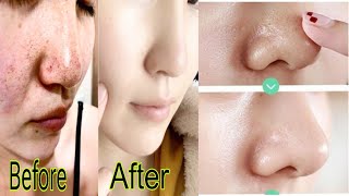 Open Pores 4 Home Remedy For Oily Skin How To Close Open Pores On Face At Home open pores minimise [upl. by Frulla752]