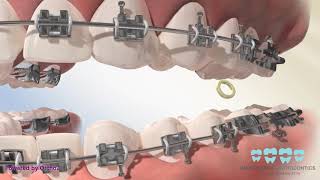 Posterior Crossbite Elastics [upl. by Torras]