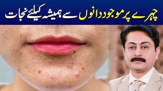 Acne treatment at home Herbal remedies  Dr Faisal Syed [upl. by Assenar682]