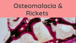 Osteomalacia and Rickets  Pathology mini tutorials [upl. by Eecart]