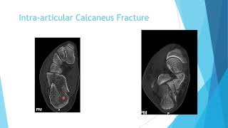 Calcaneus Fracture [upl. by Leizo]