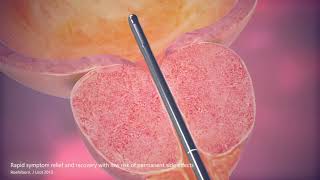 The UroLift System  Procedure Animation [upl. by Airetas]