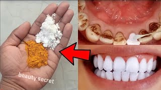 easy teeth whitening at home [upl. by Pris388]