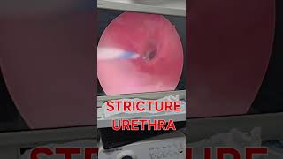 How stricture urethra look urethralstricturetreatment urethralstricture strictureurethra [upl. by Anjela]