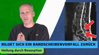 Bandscheibenvorfall verschwunden Ist eine Heilung möglich Resorption [upl. by Berman630]