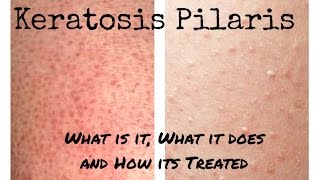 All About Skin  Keratosis Pilaris KP and more  My Skin Story [upl. by Dasteel]