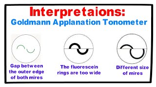 Interpretations Goldmann Applanation Tonometer [upl. by Gupta]