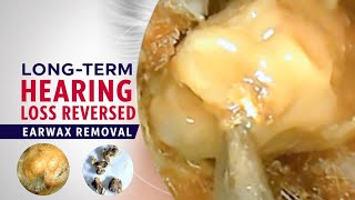 LongTerm Hearing Loss Reversed by Earwax Removal [upl. by Aicineohp829]