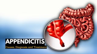 Appendicitis Causes Signs and Symptoms Diagnosis and Treatment [upl. by Sarine]