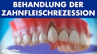 Zahnfleischrückgang – Behandlung der Zahnfleischrezession © [upl. by Hareehat]