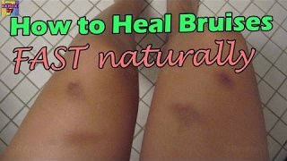 How To Remove Bruises fast Naturally  How to heal bruised on bodies ♥NEW [upl. by Htezzil]