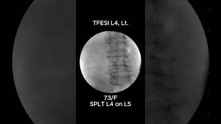 How to Accurately Perform L4 Transforaminal Epidural Steroid Injection TFESI 1 [upl. by Patric]