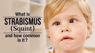 Strabismus in Kids  Cause and Treatment  Squint Eye [upl. by Meekar]