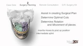 OsteoMed and Med CAD Present Orthognathic Surgery Planning [upl. by Eiaj]