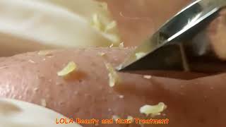 Nonstop Plucking of Whiteheads on the Nose with a Tweezer [upl. by Ahsiloc]