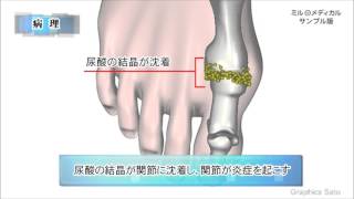 痛風／2分で分かる医療動画辞典 ミルメディカル [upl. by Jordison]