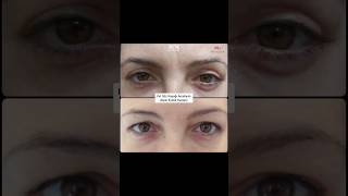 Üst Göz Kapağı Ameliyatı Upper Eyelid Surgery [upl. by O'Dell]