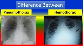 Difference between Pneumothorax and Hemothorax [upl. by Dyan]